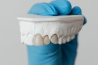 Kaboompics - Close-Up of Upper Plaster Model Showing Front Dental Crowns