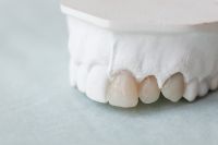 Kaboompics - Close-Up of Front Dental Crowns on a Plaster Model